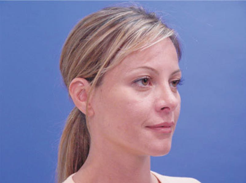 Primary Rhinoplasty Before & After Gallery - Patient 381798 - Image 3