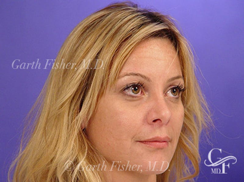 Primary Rhinoplasty Before & After Gallery - Patient 381798 - Image 4