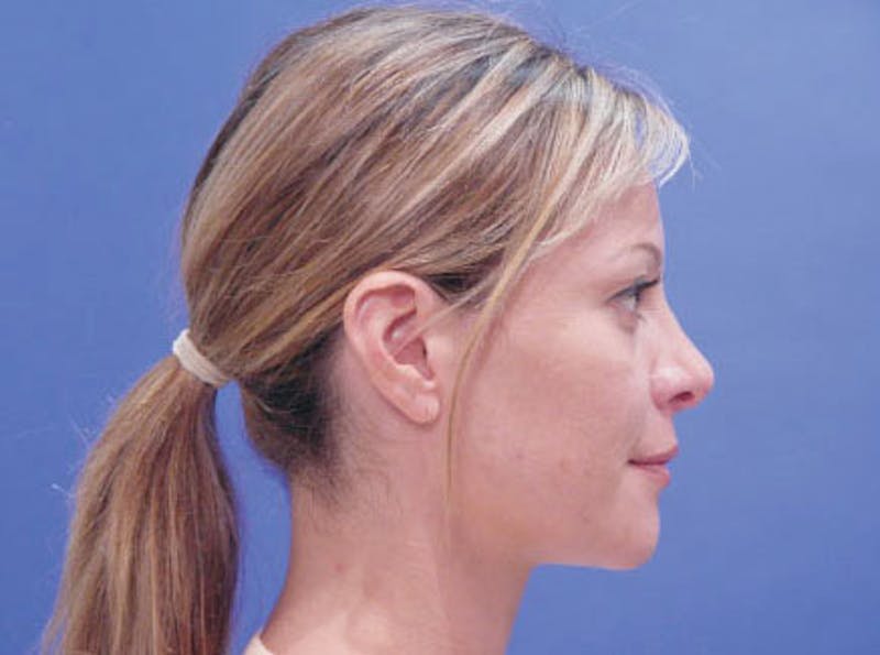 Primary Rhinoplasty Before & After Gallery - Patient 381798 - Image 5
