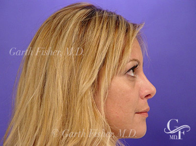 Primary Rhinoplasty Before & After Gallery - Patient 381798 - Image 6