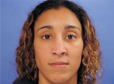 Ethnic Rhinoplasty Before & After Gallery - Patient 308521 - Image 1