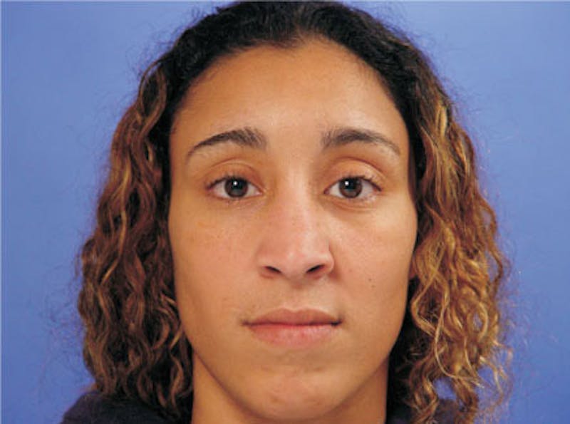 Ethnic Rhinoplasty Before & After Gallery - Patient 308521 - Image 1