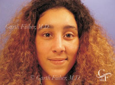 Ethnic Rhinoplasty Before & After Gallery - Patient 308521 - Image 2
