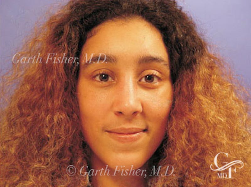 Ethnic Rhinoplasty Before & After Gallery - Patient 308521 - Image 2