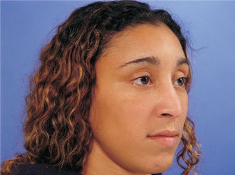 Ethnic Rhinoplasty Before & After Gallery - Patient 308521 - Image 3