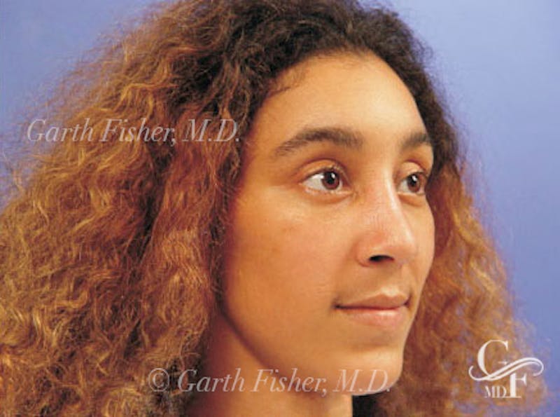 Ethnic Rhinoplasty Before & After Gallery - Patient 308521 - Image 4