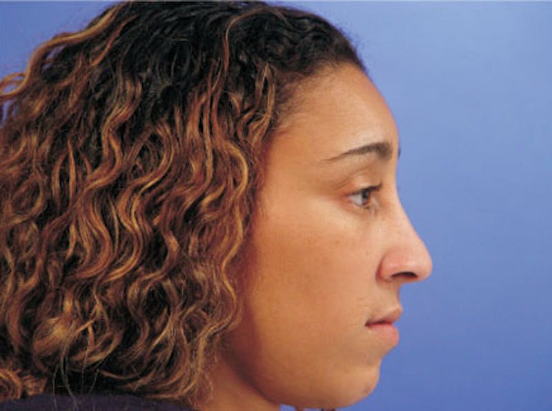 Ethnic Rhinoplasty Before & After Gallery - Patient 308521 - Image 5
