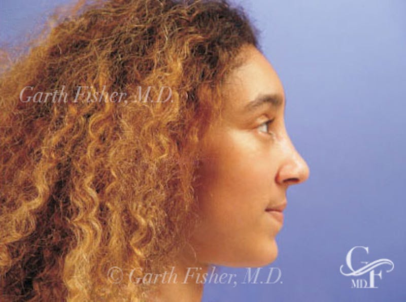 Ethnic Rhinoplasty Before & After Gallery - Patient 308521 - Image 6