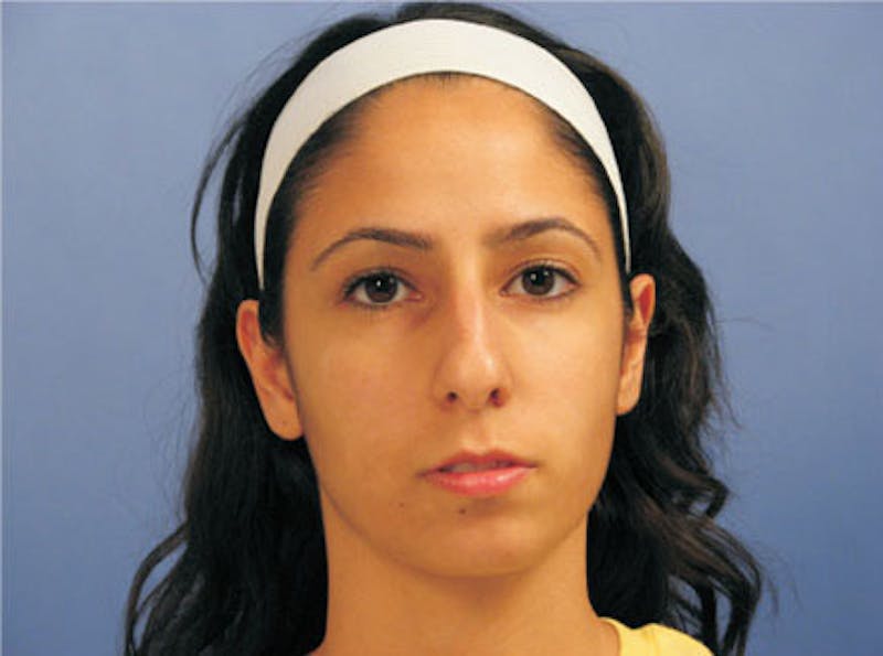 Primary Rhinoplasty Before & After Gallery - Patient 328978 - Image 1