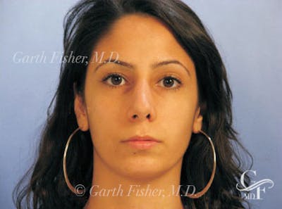 Primary Rhinoplasty Before & After Gallery - Patient 328978 - Image 2