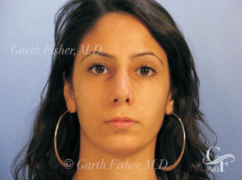 Primary Rhinoplasty Before & After Gallery - Patient 328978 - Image 2
