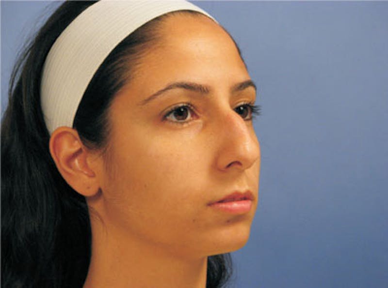 Primary Rhinoplasty Before & After Gallery - Patient 328978 - Image 3