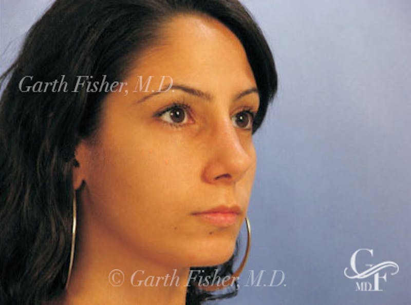 Primary Rhinoplasty Before & After Gallery - Patient 328978 - Image 4