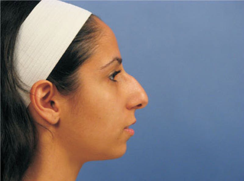 Primary Rhinoplasty Before & After Gallery - Patient 328978 - Image 5