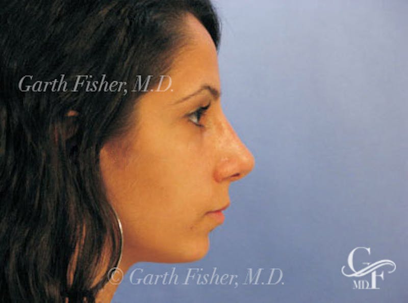 Primary Rhinoplasty Before & After Gallery - Patient 328978 - Image 6