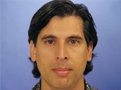 Primary Rhinoplasty Before & After Gallery - Patient 131454 - Image 1