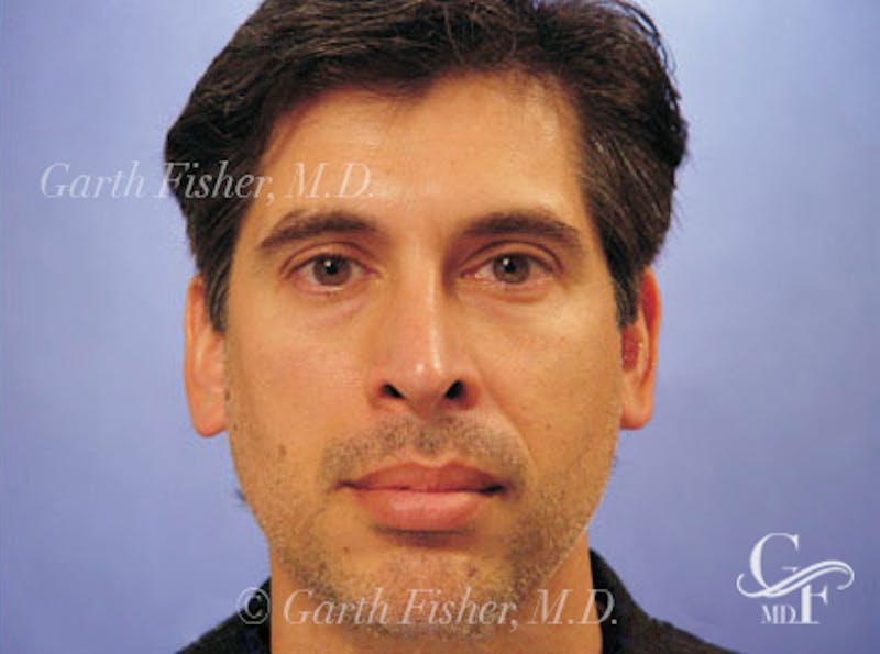 Primary Rhinoplasty Before & After Gallery - Patient 131454 - Image 2