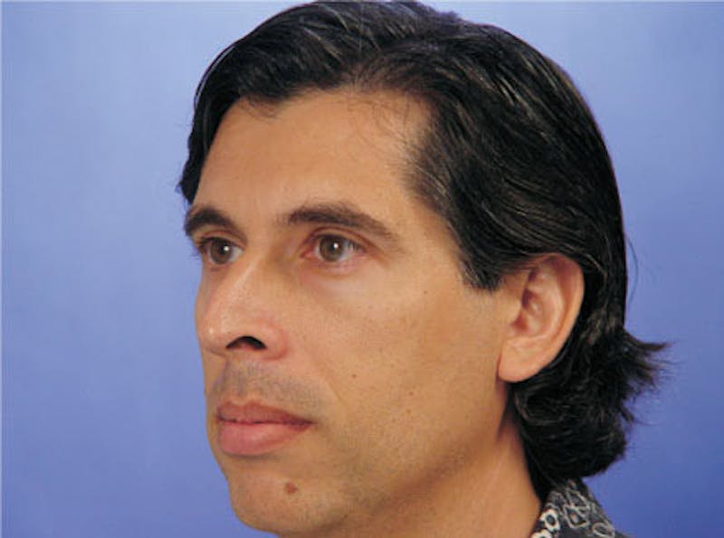 Primary Rhinoplasty Before & After Gallery - Patient 131454 - Image 3