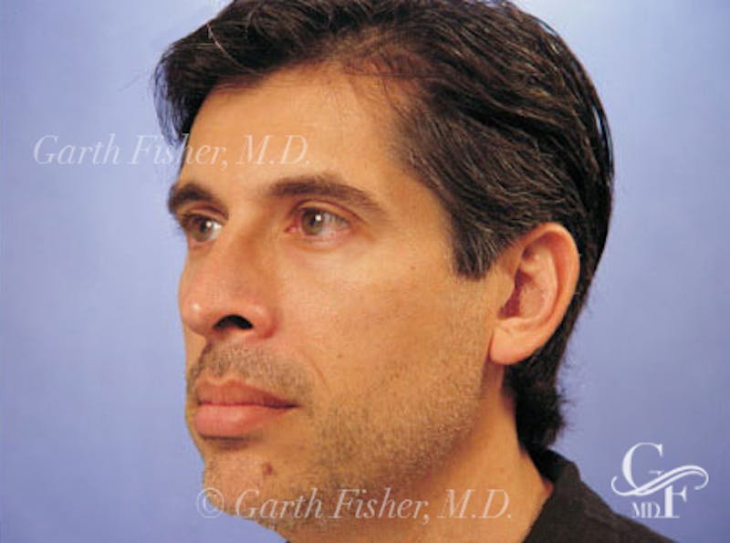 Primary Rhinoplasty Before & After Gallery - Patient 131454 - Image 4