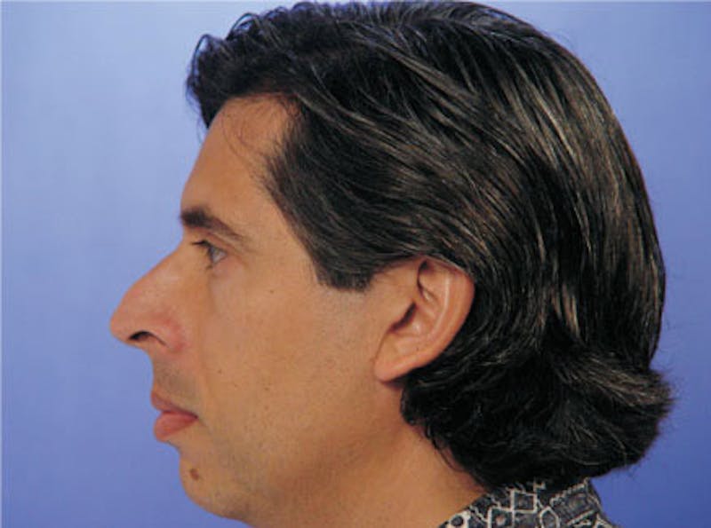 Primary Rhinoplasty Before & After Gallery - Patient 131454 - Image 5