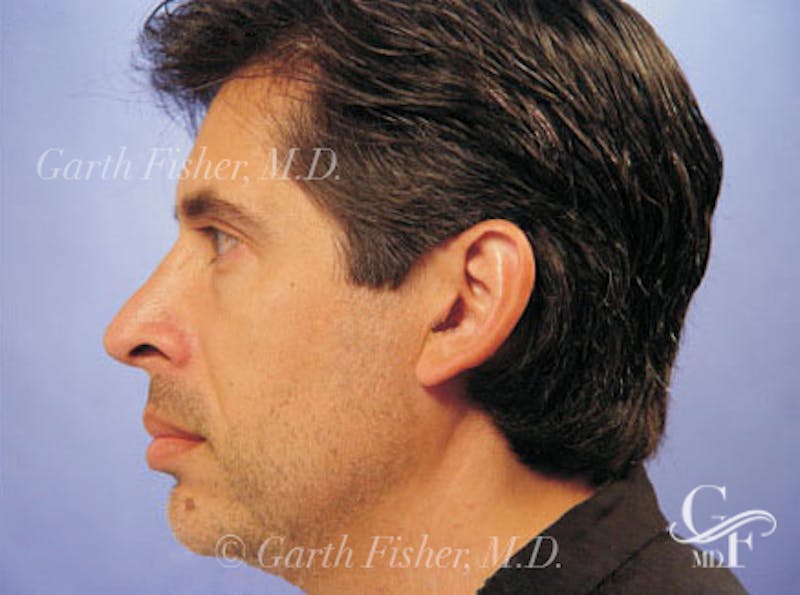 Primary Rhinoplasty Before & After Gallery - Patient 131454 - Image 6