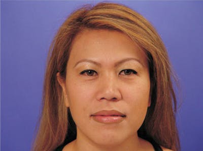 Ethnic Rhinoplasty Before & After Gallery - Patient 117053 - Image 1