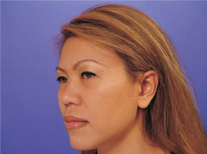 Ethnic Rhinoplasty Before & After Gallery - Patient 117053 - Image 3