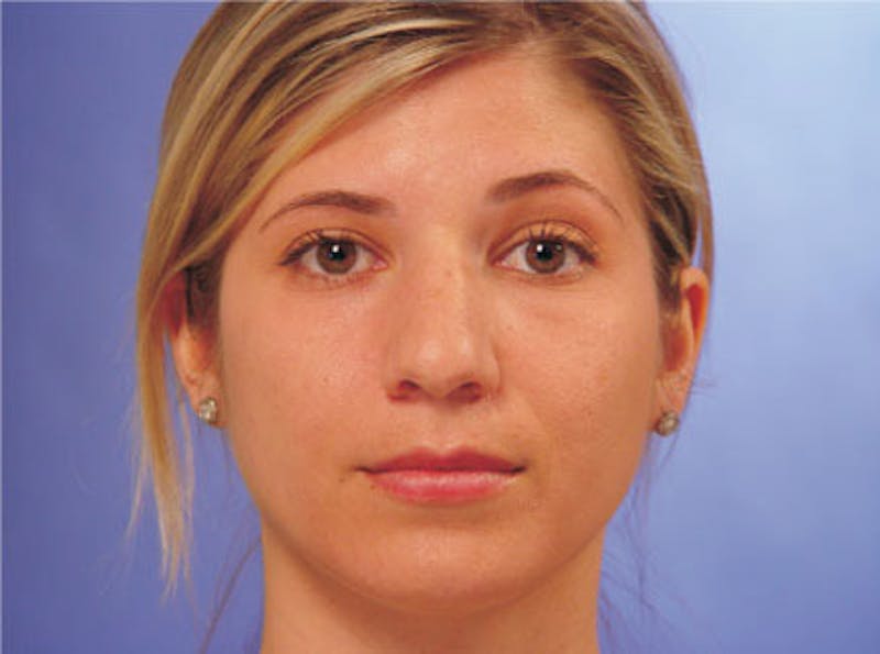 Primary Rhinoplasty Before & After Gallery - Patient 201877 - Image 1