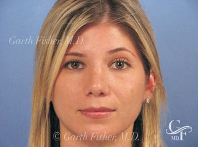 Primary Rhinoplasty Before & After Gallery - Patient 201877 - Image 2