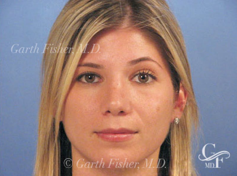 Primary Rhinoplasty Before & After Gallery - Patient 201877 - Image 2