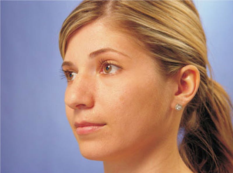 Primary Rhinoplasty Before & After Gallery - Patient 201877 - Image 3
