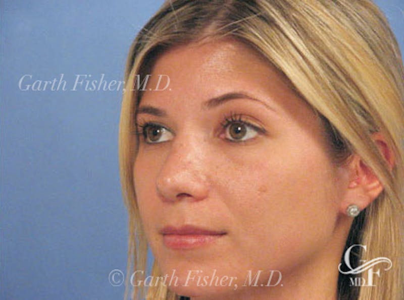 Primary Rhinoplasty Before & After Gallery - Patient 201877 - Image 4
