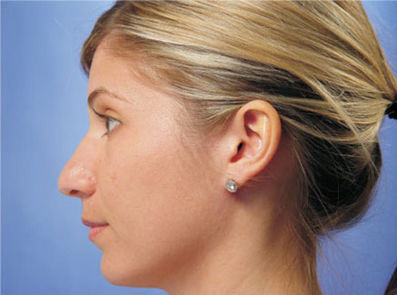 Primary Rhinoplasty Before & After Gallery - Patient 201877 - Image 5