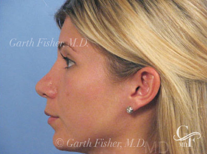 Primary Rhinoplasty Before & After Gallery - Patient 201877 - Image 6