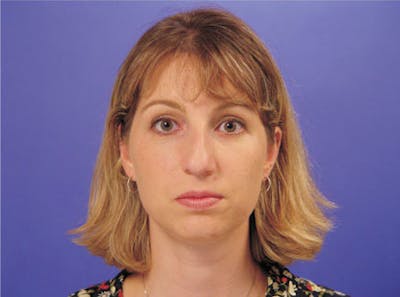 Primary Rhinoplasty Before & After Gallery - Patient 339138 - Image 1