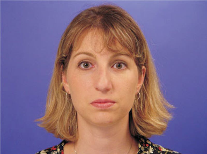 Primary Rhinoplasty Before & After Gallery - Patient 339138 - Image 1
