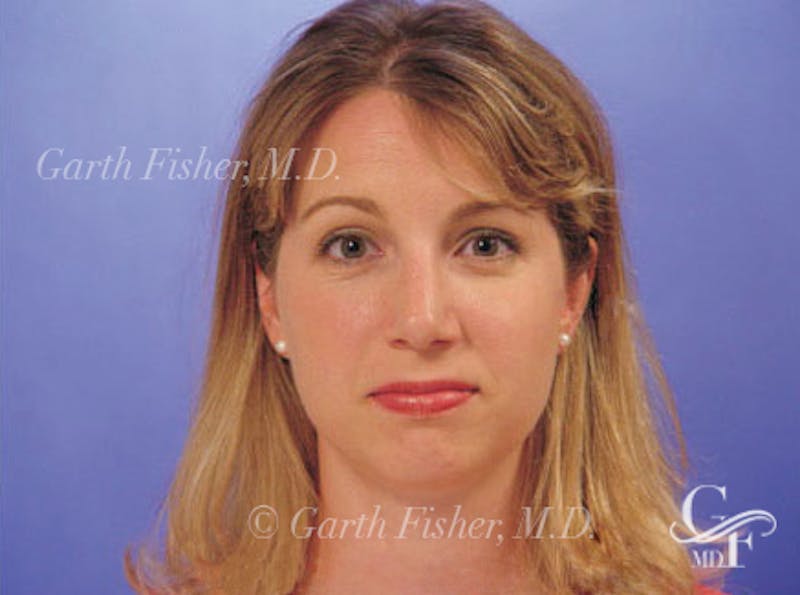 Primary Rhinoplasty Before & After Gallery - Patient 339138 - Image 2