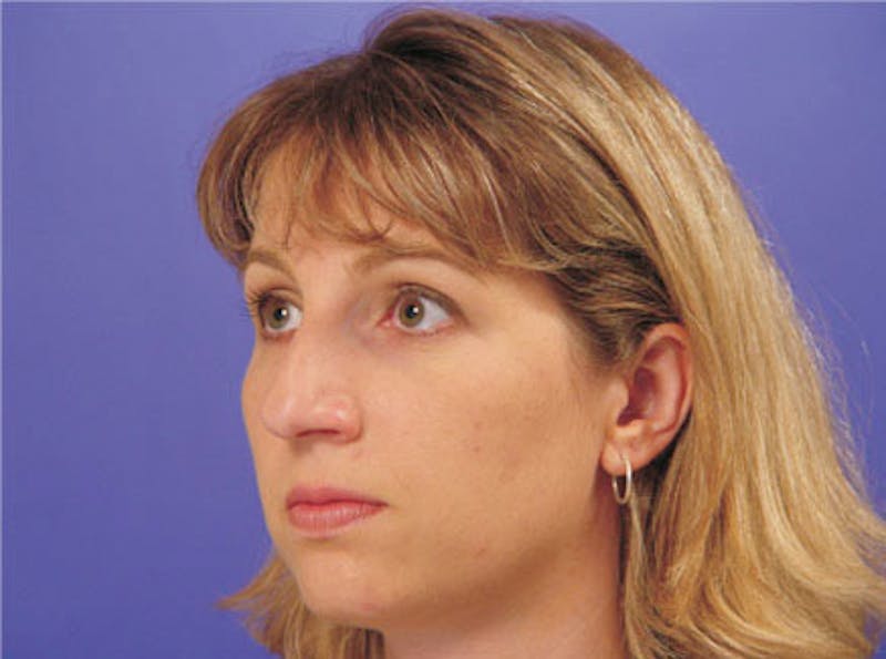 Primary Rhinoplasty Before & After Gallery - Patient 339138 - Image 3