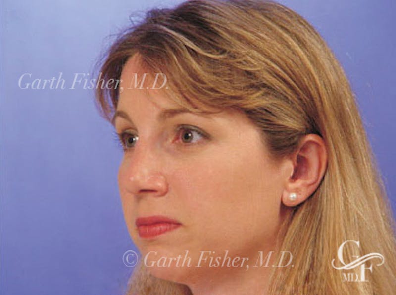 Primary Rhinoplasty Before & After Gallery - Patient 339138 - Image 4