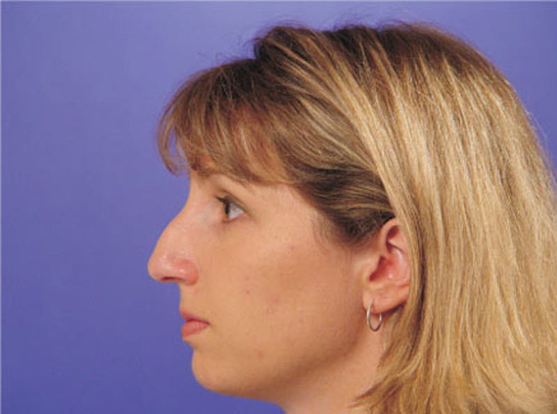 Primary Rhinoplasty Before & After Gallery - Patient 339138 - Image 5