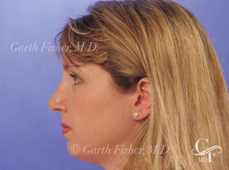 Primary Rhinoplasty Before & After Gallery - Patient 339138 - Image 6