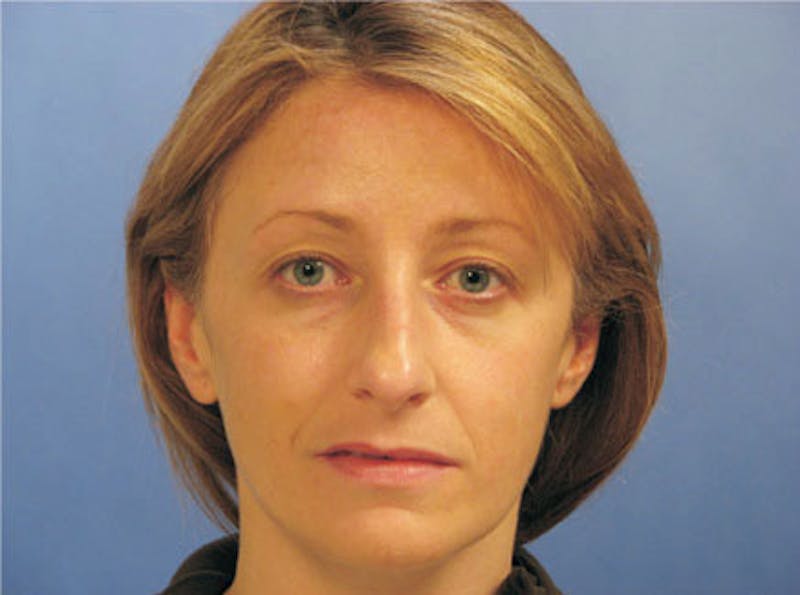 Primary Rhinoplasty Before & After Gallery - Patient 859070 - Image 1