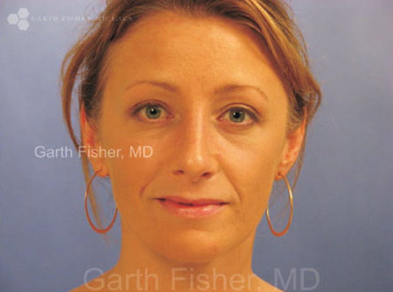 Primary Rhinoplasty Before & After Gallery - Patient 859070 - Image 2