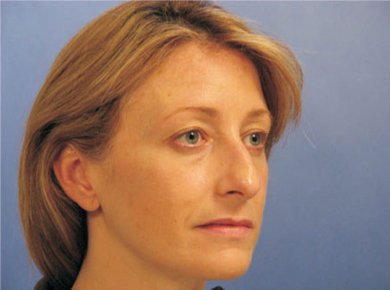 Primary Rhinoplasty Before & After Gallery - Patient 859070 - Image 3