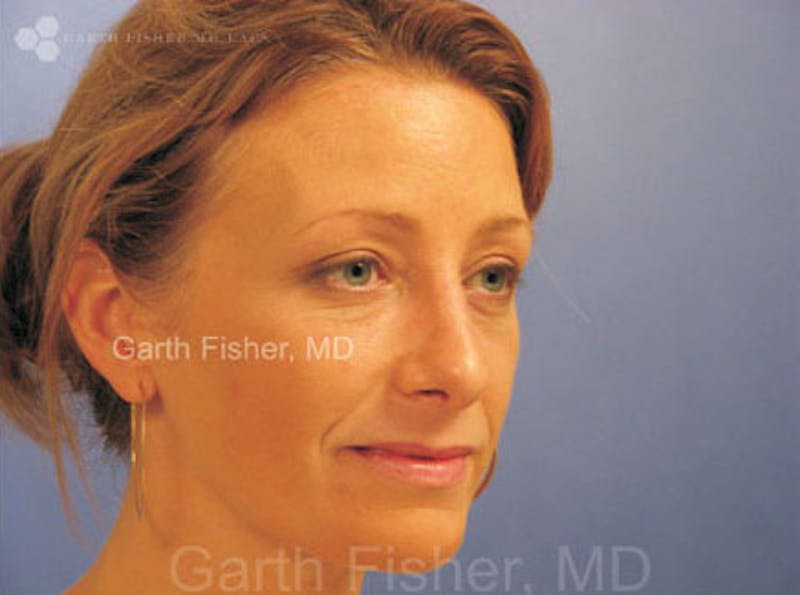 Primary Rhinoplasty Before & After Gallery - Patient 859070 - Image 4