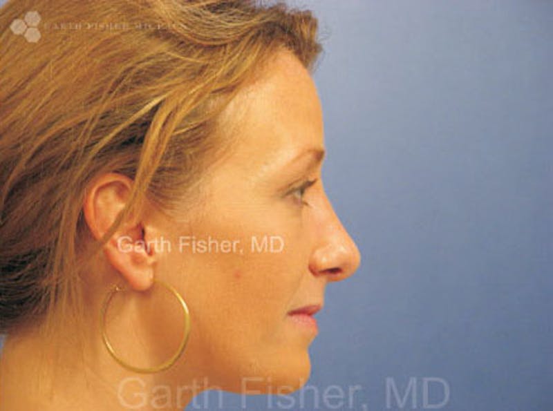 Primary Rhinoplasty Before & After Gallery - Patient 859070 - Image 6