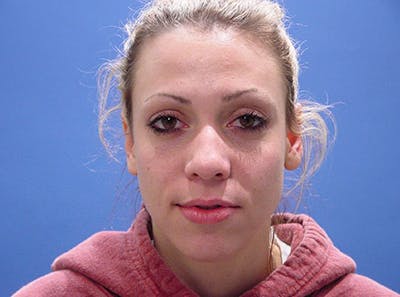 Primary Rhinoplasty Before & After Gallery - Patient 989585 - Image 1