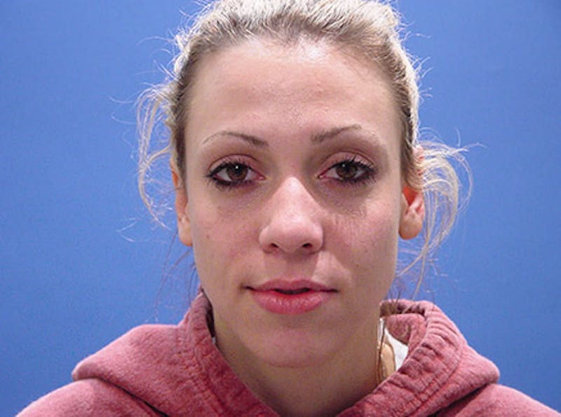 Primary Rhinoplasty Before & After Gallery - Patient 989585 - Image 1