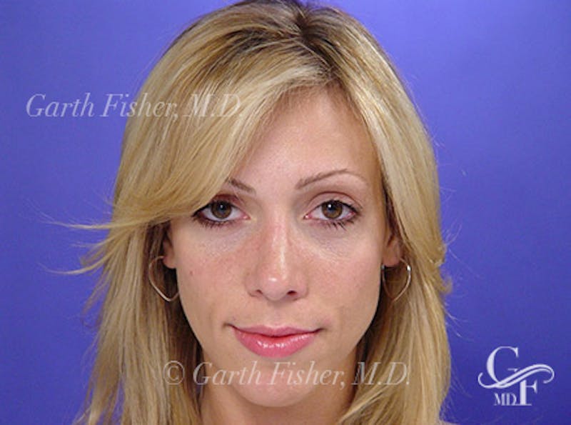 Primary Rhinoplasty Before & After Gallery - Patient 989585 - Image 2