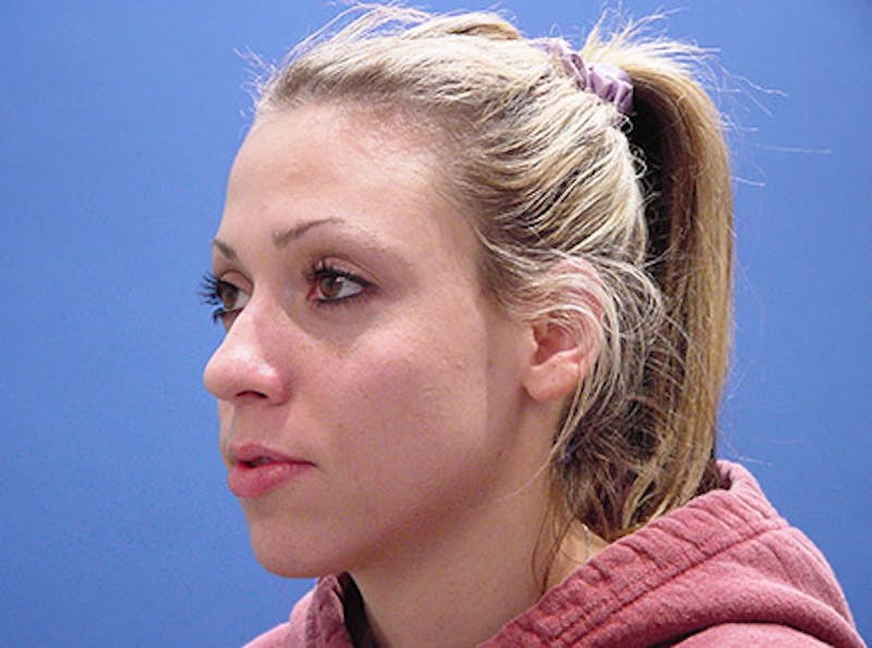Primary Rhinoplasty Before & After Gallery - Patient 989585 - Image 3